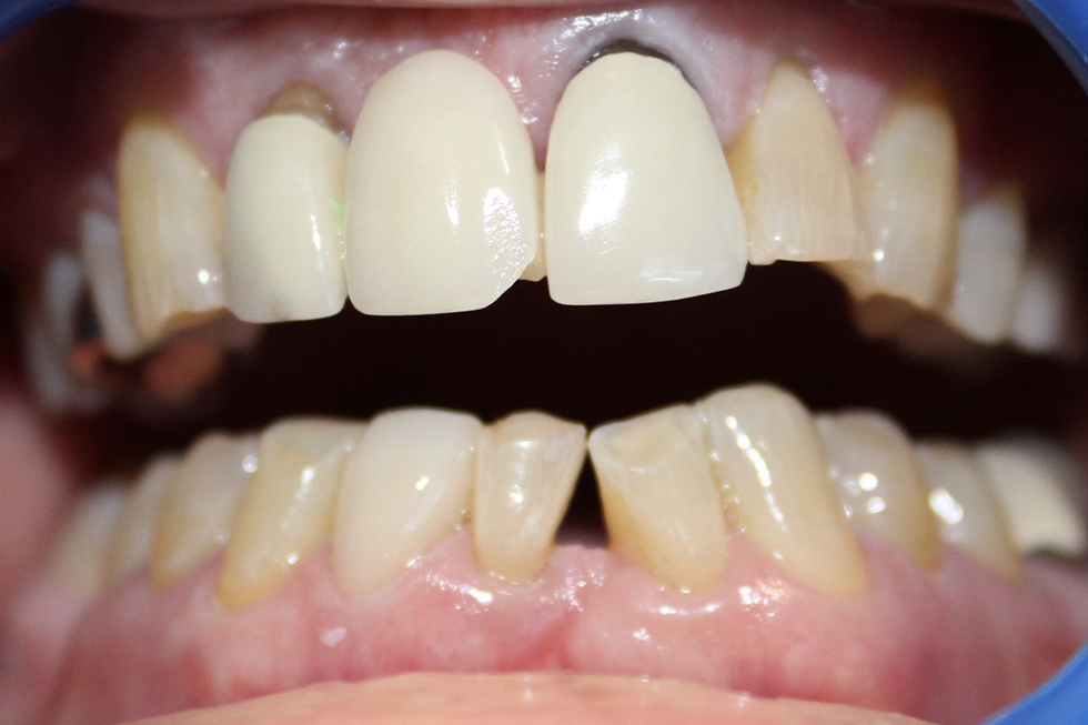 before and after cosmetic dentistry
