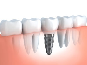 3d dental implant graphic